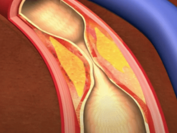 Aggeioplastiki Aggeioplastiki